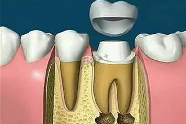 戴牙套后牙疼怎么辦?拔牙后什么時候應該戴牙套?