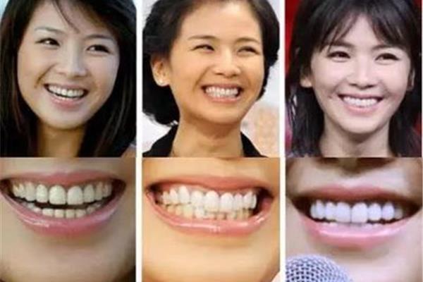 牙齒美容可以管多久,整容牙齒有后遺癥嗎?
