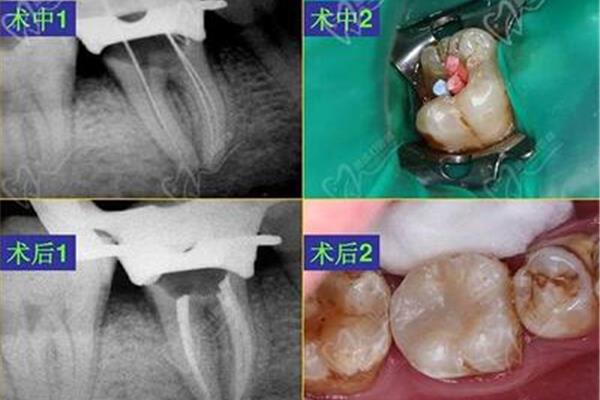 根管治疗 牙根能活多久