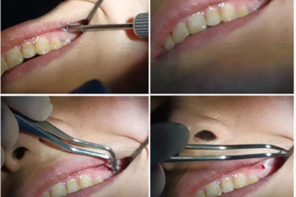 牙齒矯正為什么要植入「骨釘」?牙套什么時候拆?