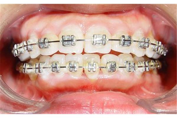 正畸金属托槽要带多久(一般多久带一次牙齿矫正器?)