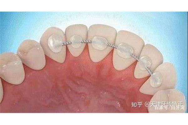 用固位体带牙套需要多长时间(带牙套后持续多久)