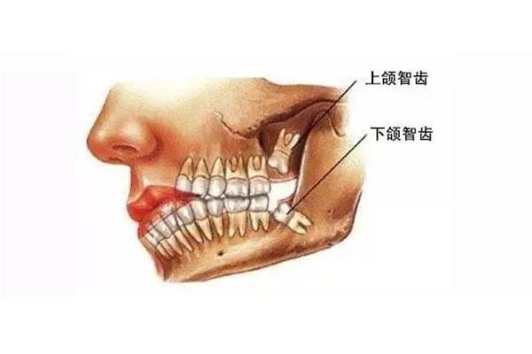 上頜第三磨牙難拔嗎?第三磨牙的治療