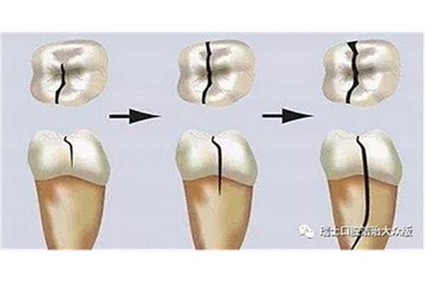 外伤牙齿松动需要多长时间恢复(外伤牙齿松动的最佳补救措施)
