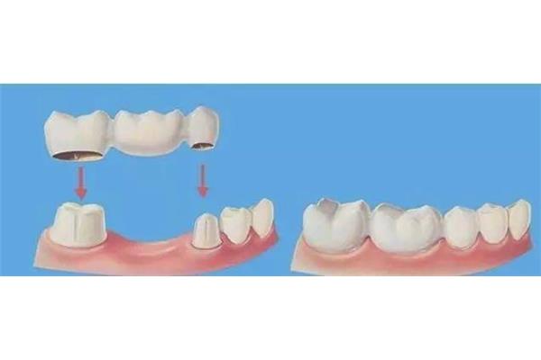 牙齒多久不會變形,牙齒多久能正常進食?