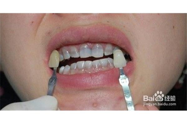 补牙装牙套要多少钱(带牙套要多久?)