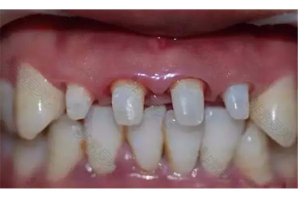 磨牙后多久牙冠會痛,多久才是牙冠?