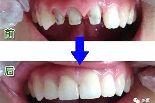 把縫隙大的牙齒拉直要多久?傳統正畸的步驟有哪些?