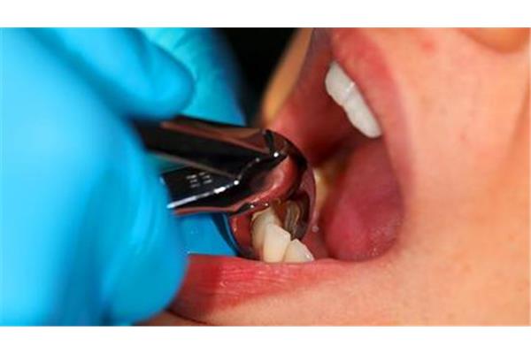 化脓性牙髓炎会疼多久(关于牙髓炎)