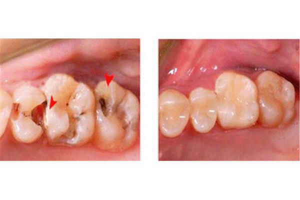 牙齿恢复正常饮食需要多长时间(牙齿恢复正常进食需要多长时间)