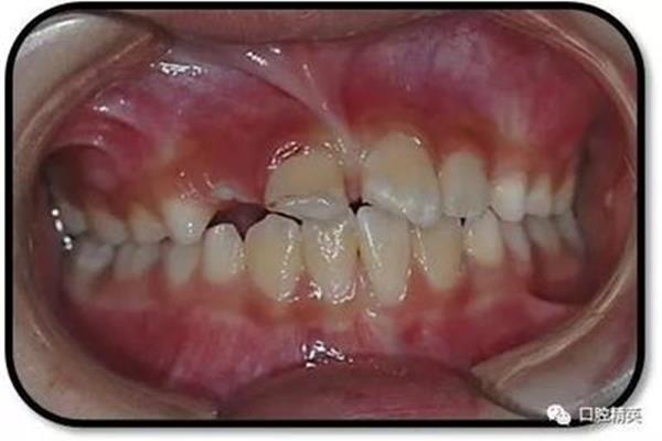修复性牙本质形成需要多长时间(牙齿闭合手术是什么意思)