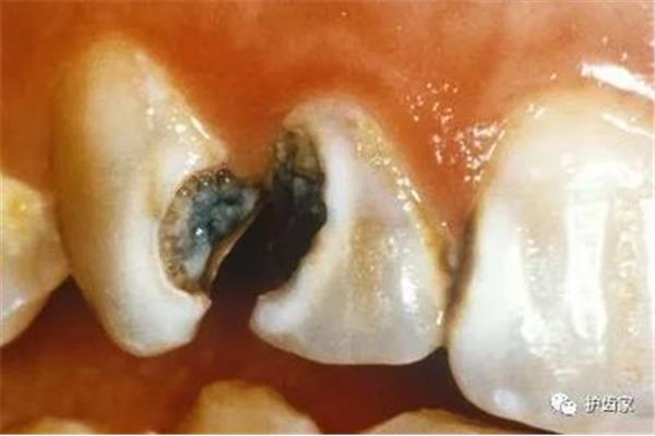 牙根有裂紋還能用多久