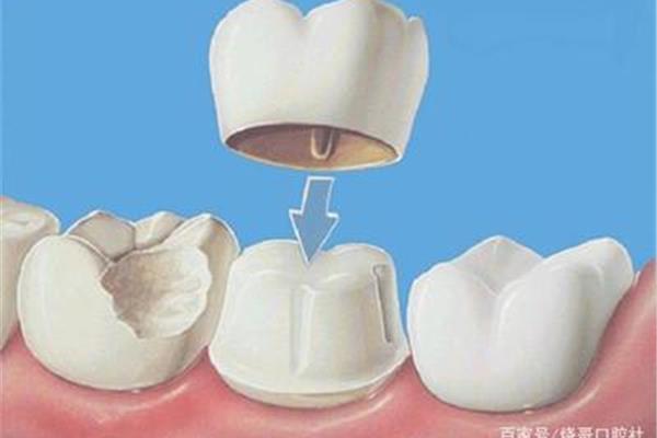 根管治療和根管充填后做一個牙冠需要多久?