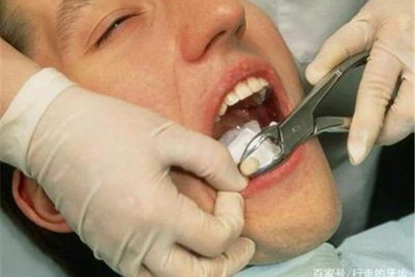 减少拔牙后出血的品管圈(拔牙后一直出血怎么办)