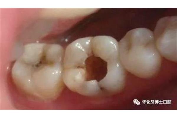 拔牙后能補其他牙多久,拔牙后能補其他牙的齲齒多久?