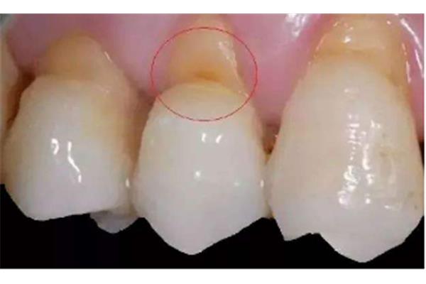 打桩修复的牙齿寿命(根管治疗的牙齿寿命有多长)