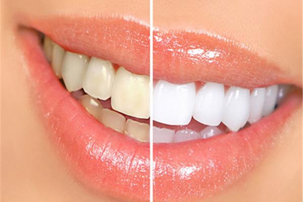 洗牙后多久可以做美白?牙齒美白的醫學美白方法