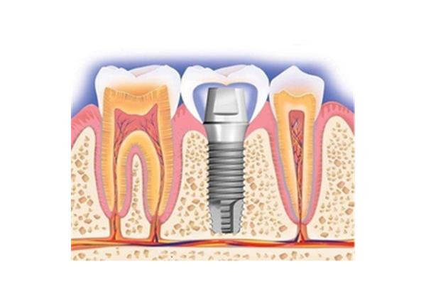 氧化鋯全瓷牙能用多久,1000顆全瓷牙能用多久?