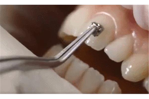 隱形牙套的附著體應該貼多久?剛貼牙套能吃多久?