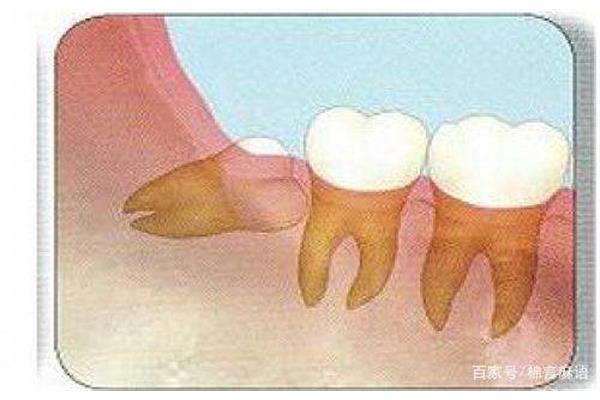 智齿牙龈疼痛的原因是什么(智齿长在牙龈边的图片)