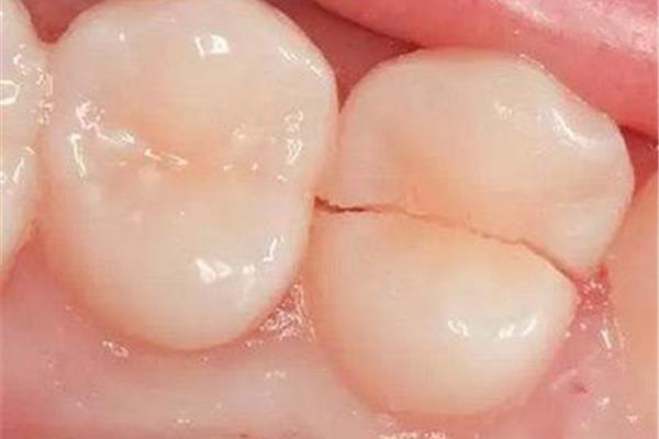 蛀牙牙痛一般会痛多久(蛀牙痛会痛多久)