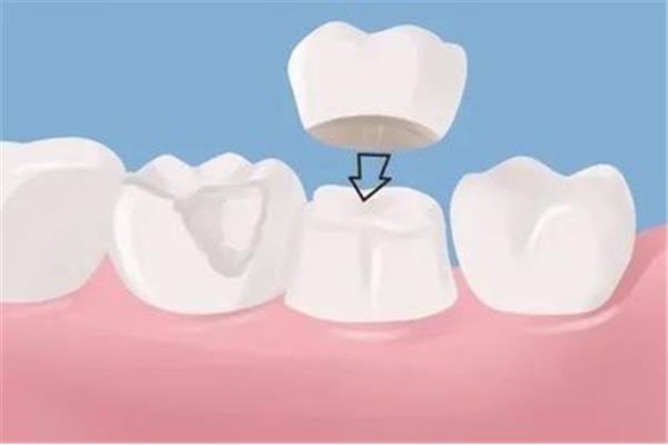 做牙套治療需要多久,牙齒治療后多久可以帶牙套?