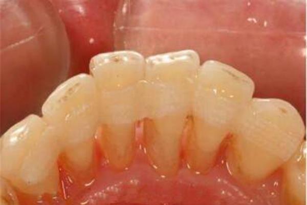 松动的牙齿可以修复吗(松动的牙齿,需要多长时间修复)
