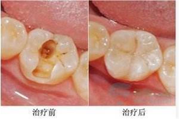 補牙需要多長時間?側洞可以修復嗎?