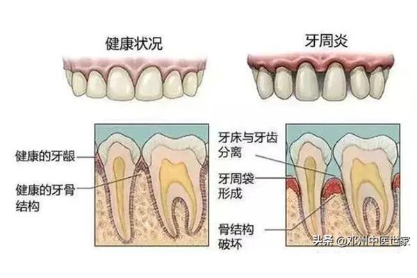 牙周治疗每次要多久