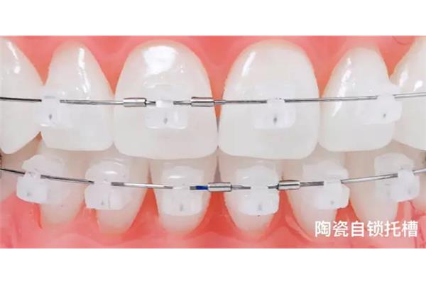 透明塑料牙套怎么清洗(隱形牙套是什么?)
