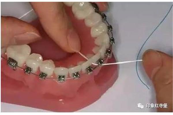 牙科器械的清潔(如何清潔牙套)