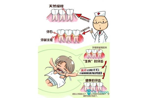 防止牙周病