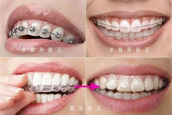 隱形牙套對牙齒矯正效果好嗎?(如何佩戴透明牙具)