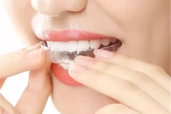 正畸牙套有哪些類型(關于透明牙套,急!!)