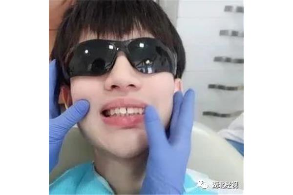 缺失門牙的正畸牙套(缺失門牙的正畸)