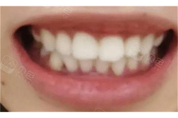 牙齒矯正后,可以改變突出的嘴巴嗎?(為什么戴牙套后嘴巴更凸出?)