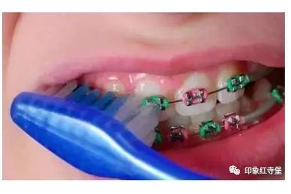 牙齒矯正器真的有用嗎(用牙套矯正牙齒會疼多久?)