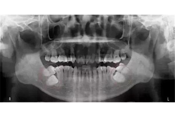 牙齒擦除不正確(正畸治療有什么區別)