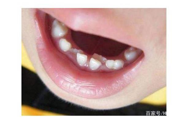 孩子換牙怎么辦?(孩子一般幾歲換牙?)