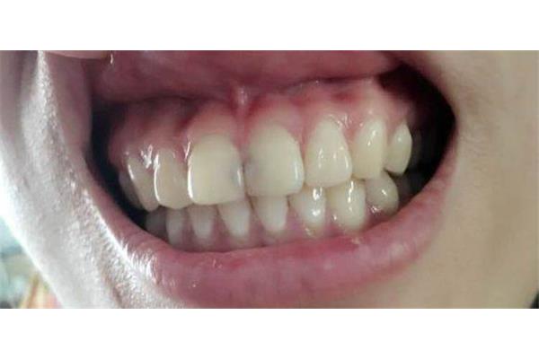 牙齒略骨(什么是骨齙牙,牙齙牙)