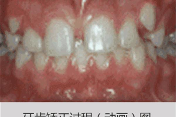 Xi安虎牙矯正需要多久(小虎牙需要矯正嗎)?