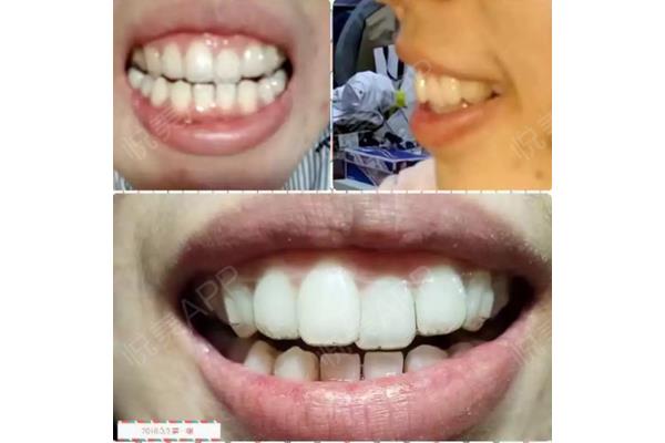 戴牙套會改變牙齒的臉型嗎(牙齒可以矯正改善臉型嗎?)