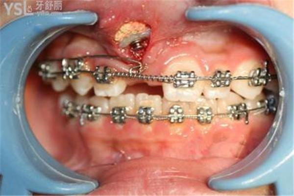 矯正脫臼的牙齒需要多長時間(矯正牙齒后不滿意可以矯正哪些牙齒)
