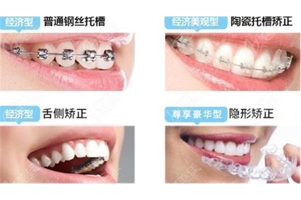 牙齒矯正器品牌