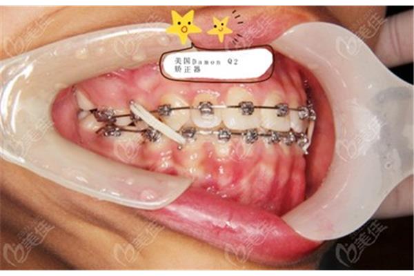 牙套透明牙套(牙套有透明牙套嗎)