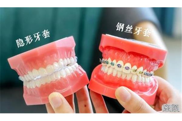 如何選擇牙套(如何選擇正畸矯治器?)