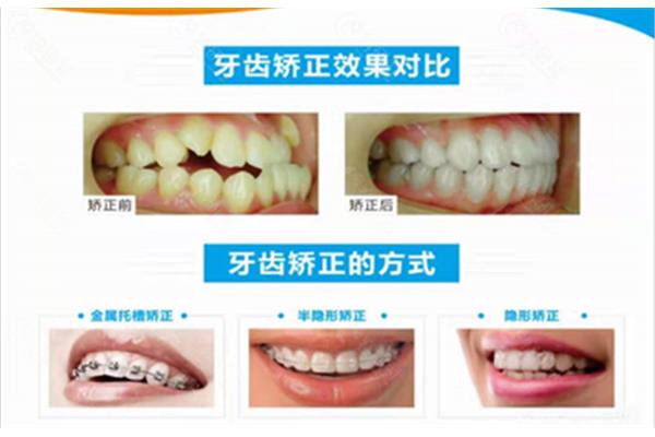 牙齒矯正的費用是多少?南京哪家醫院牙科治療又好又便宜?