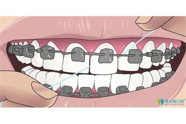 如何矯正牙齒(矯正牙齒最好的方法是什么?)