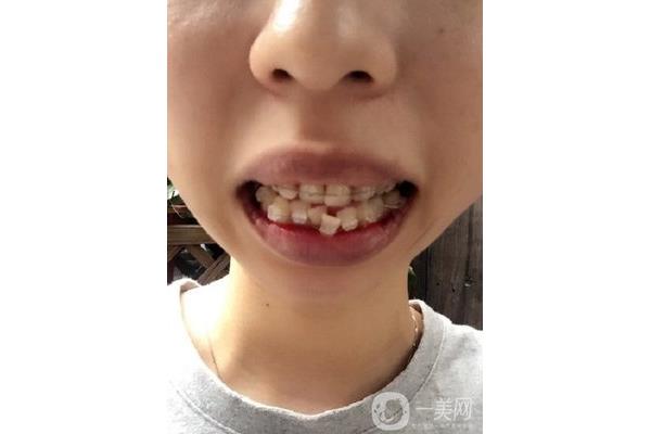 成年人的牙齒可以矯正嗎(8歲小孩牙齒長歪了怎么辦)
