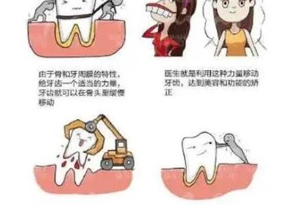補牙裝牙套多少錢?用牙套矯正牙齒要多少錢?)